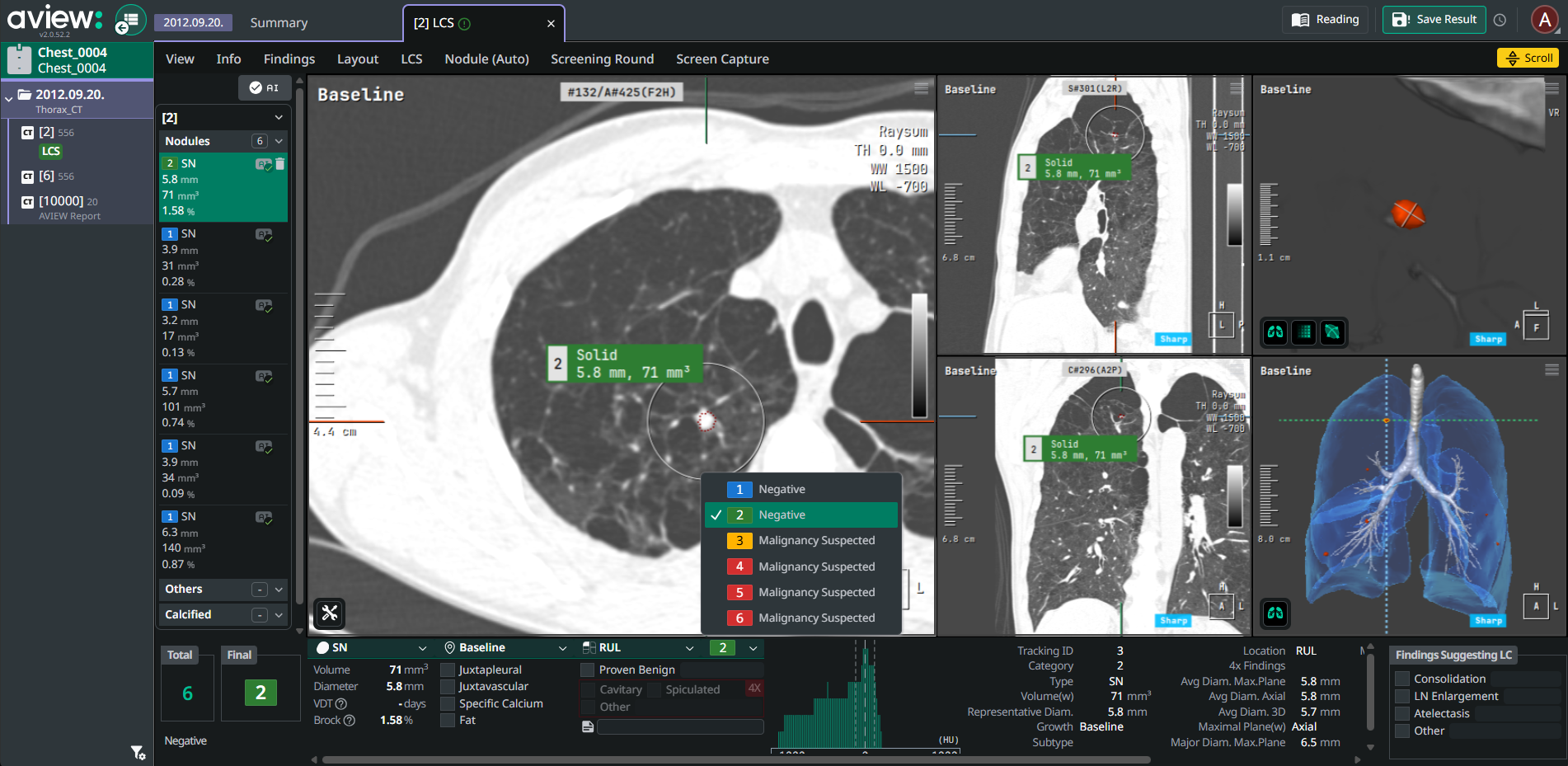코어라인소프트, AVIEW LCS 구독 확대…폐검진 변화
